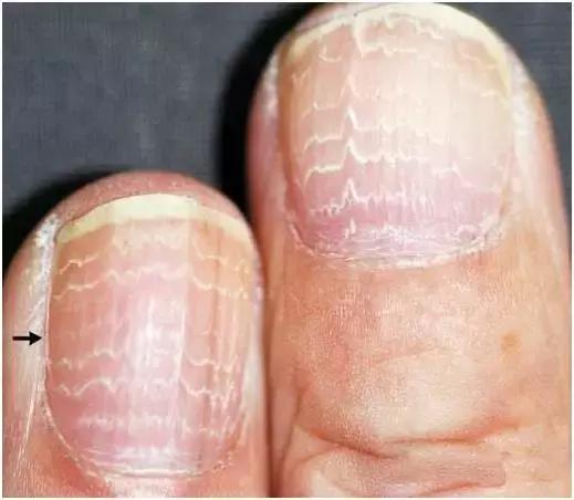 指甲变色变厚怎么处理,指甲变色了怎么办