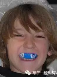 恒牙换牙不,恒牙不长出