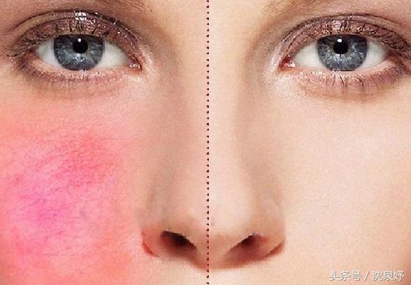 毛孔粗大问题应该如何正确解决,毛孔粗大还有救吗到底要如何解决