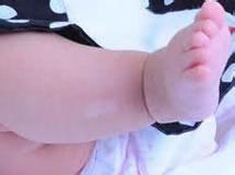 生了小孩之后得了白癜风会遗传吗,白癜风如何避免白癜风遗传给孩子