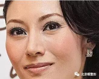 鱼尾纹，这样除最简单，一针即刻见效！