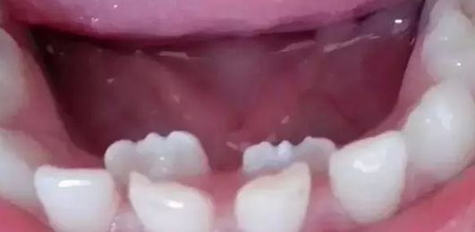 小孩开始换牙了,宝爸宝妈看过来你家宝贝换牙了吗