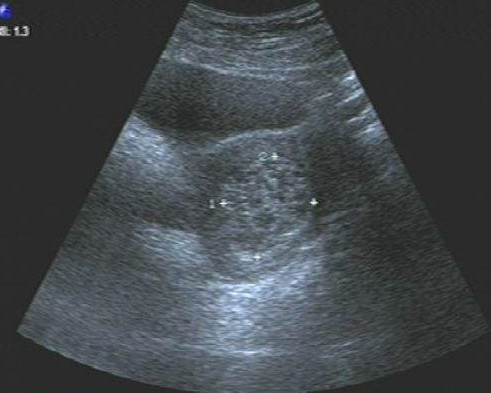 节育环在身体里面放了11年,体检发现节育环不见了