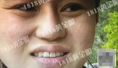 杭州时光整形医院毁容案例,杭州一女子整形