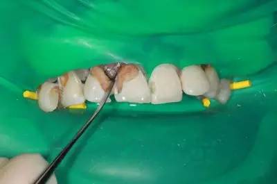 可乐牙治疗实拍,可乐牙治疗好前后图片