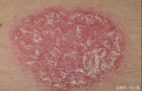 图解成年人常见的皮肤问题