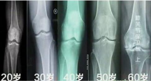 静力蹲保护膝盖吗,膝关节疼痛可以静蹲吗