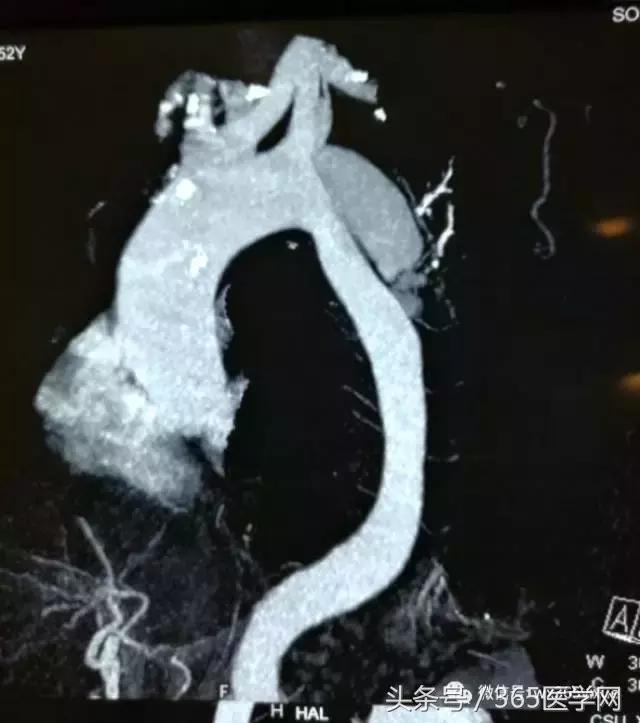 胸主动脉瘤保守治疗的方法,江西省胸科医院黄建华