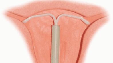 节育环在身体里面放了11年,体检发现节育环不见了