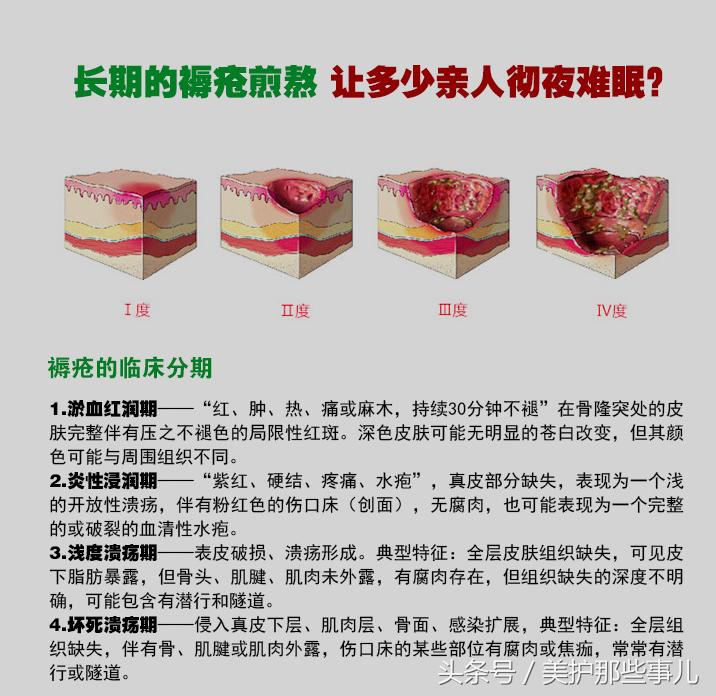 褥疮用碘伏消毒后可以用紫药水吗,老年人的褥疮能用碘酒消毒吗