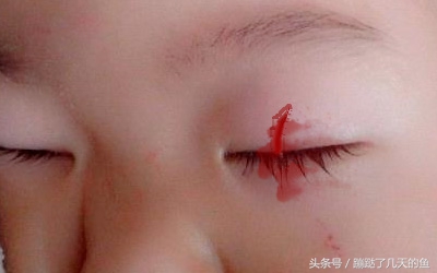 4岁小孩眼睛被戳伤幼儿园,小朋友眼睛被戳伤能自愈吗