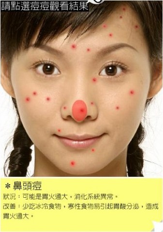 4招正确区分痘痘粉刺,粉刺是痘痘初期状态吗