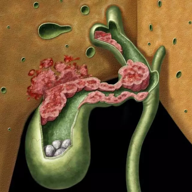 军队体检胆囊息肉标准,征兵体检胆囊息肉的标准