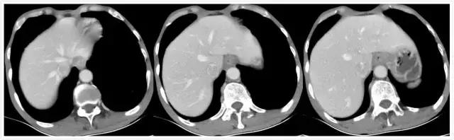 胃底贲门中分化腺癌怎么来根治,胃底贲门低中分化腺癌能治愈吗
