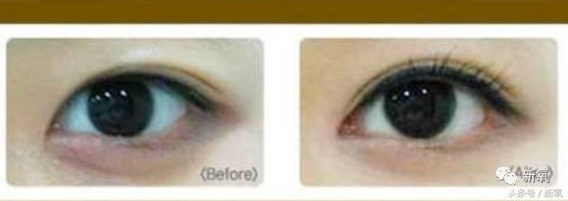 为什么开眼角会变漂亮,为什么开眼角很奇怪