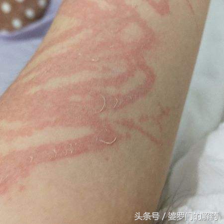 如何避免被动物咬伤,不小心被动物抓伤怎么办