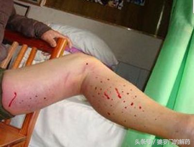 如何避免被动物咬伤,不小心被动物抓伤怎么办