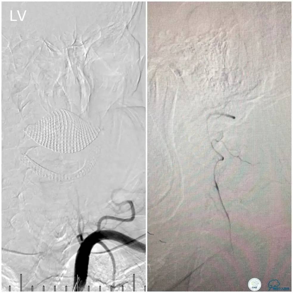 天坛周记|右椎动脉V1段及V4-基底动脉串联病变支架治疗一例