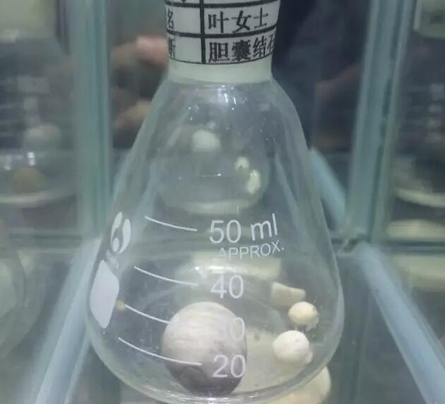 一医院设立胆结石博物馆,胆结石博物馆