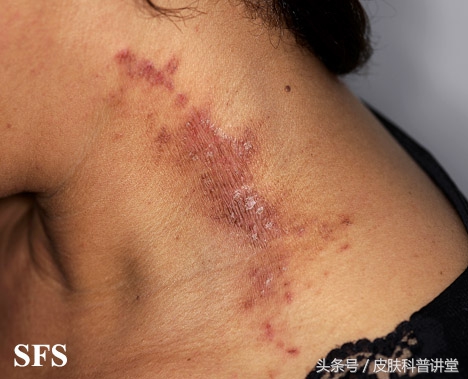 隐翅虫皮炎部位睡觉需要避开吗,晚上睡觉怎么避免隐翅虫