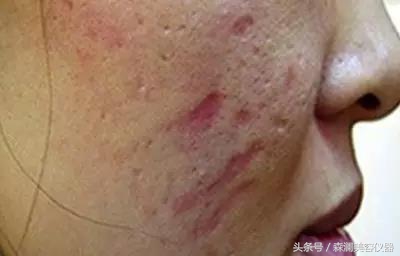 皮秒激光操作视频过程,皮秒为什么会反黑