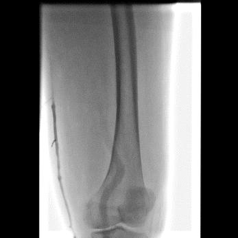 下肢肿胀有效的治疗手段是什么？