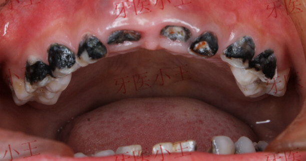 孩子牙齿烂了需要根管治疗吗,孩子牙齿坏了有洞有必要补吗