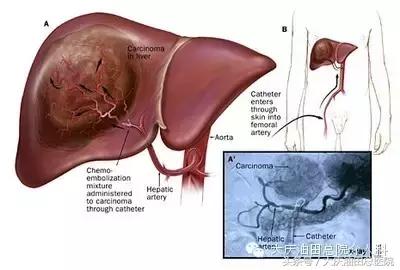 介入科治肝癌的方法,大庆油田总医院介入科
