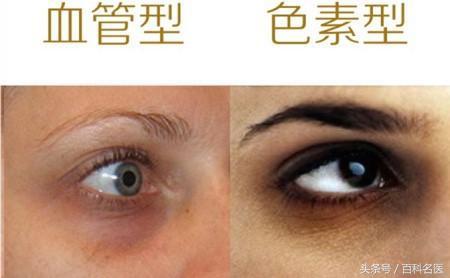 中医治疗青少年熊猫眼,消除熊猫眼的穴位