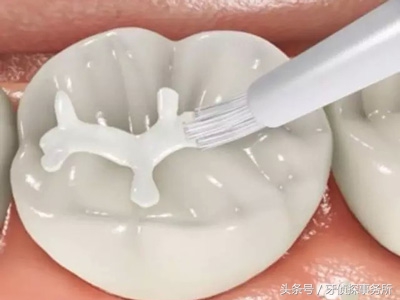 宝宝牙齿洞大怎么补救,牙齿窝沟深怎么回事