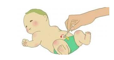 新生儿脐疝如何处理,新生儿脐疝初期怎么处理