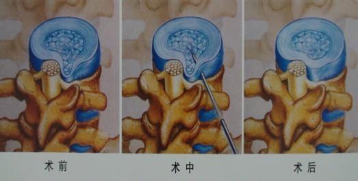 腰腿痛的诊断与非手术治疗,腰腿痛的康复治疗