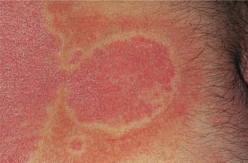 银屑病关节炎和银屑病区别,银屑病关节炎跟银屑病一样吗