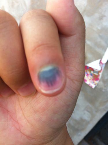 指甲被压了会感染吗,指甲被压紫了碍事吗