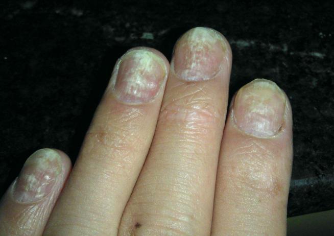 得了灰指甲用醋能好吗,灰指甲用药后面传染