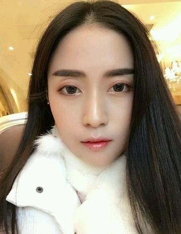 下巴后缩垫下巴案例,垫了下巴膨体皮肤松弛严重