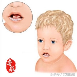 宝宝鹅口疮的大事小情