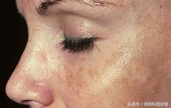 褐斑的原因和治疗方法,褐斑最佳治疗方法