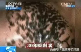 至简清肺仪对肺气肿人有效吗,肺大泡或肺气肿能不能使用清肺仪