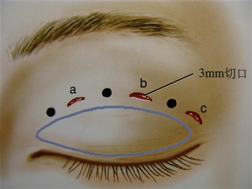 给自己点耐心：双眼皮术后一定要有一段恢复期！