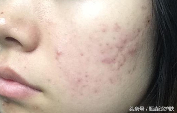 如何去除痘印,如何去除痘印留下的痣