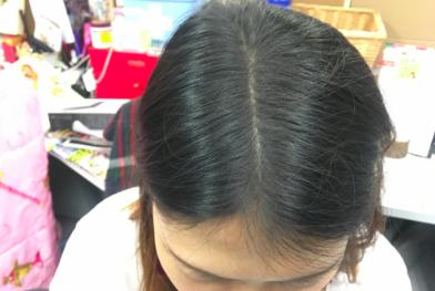 为什么没人敢去植发,为什么很多人都没有去植发