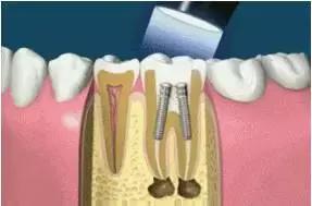 关于牙齿你不知道的小问题,牙齿根管治疗的正确方法