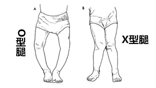 这四个,竟是导致女儿罗圈腿(O型腿)的原因
