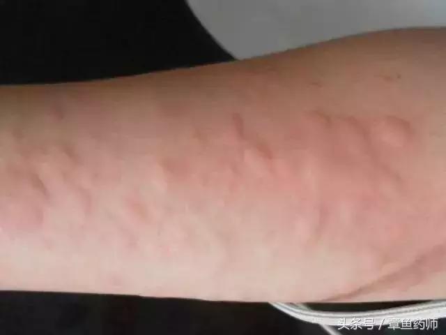 愁人的*麻疹荨**,下次带娃去医院之前一定要看看