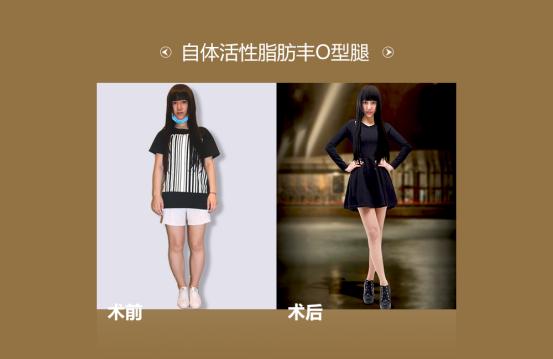 王明利自体脂肪填充好不好,王明利自体脂肪丰臀怎么样