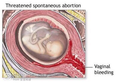 妇产科医生科普孕期出血,早孕发现出血了该怎么办