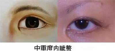 眼睛小怎么办单眼皮,眼睛小怎么办变大