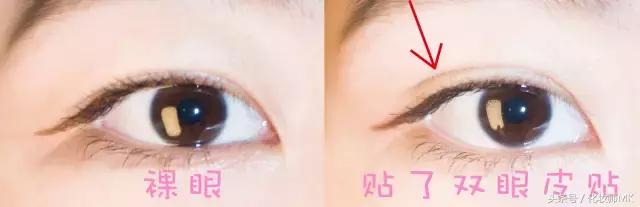 真实贴双眼皮贴,单眼皮怎么贴第二天变双眼皮