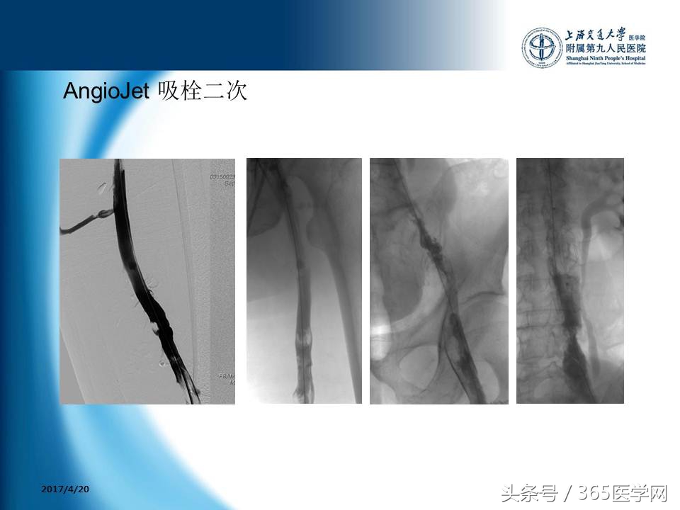下肢静脉血栓植入滤器后的护理,下肢静脉血栓滤器植入后注意事项